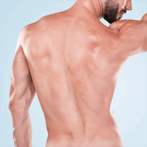 Epilation laser dos