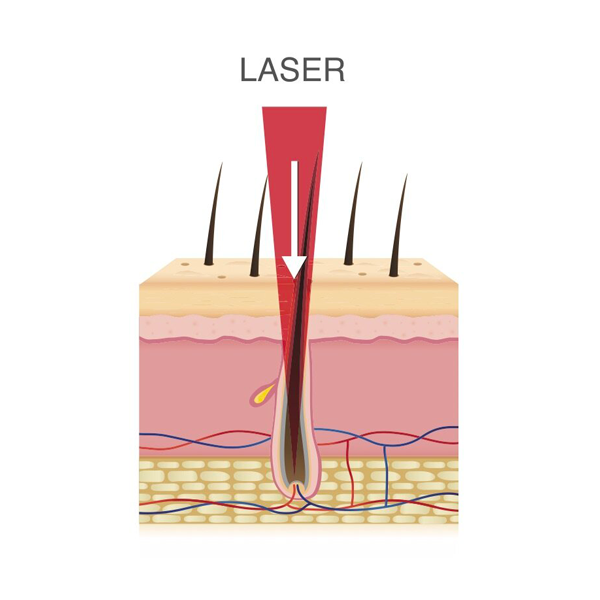 Fonctionnement de l'épilation laser