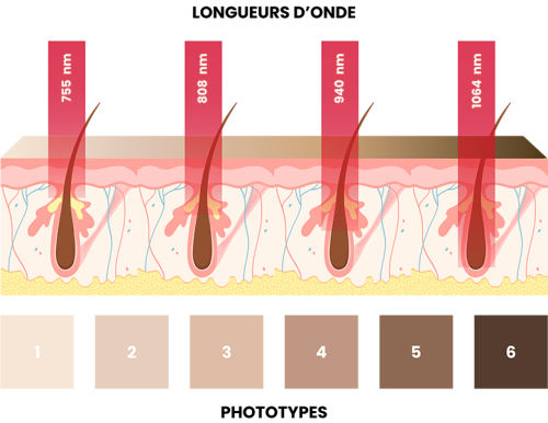 Epilation laser 4 longueurs d'onde