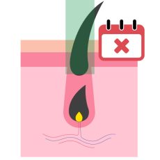 Phase anagène précoce - Epilation laser inefficace