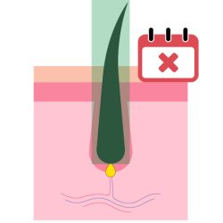 Phase catagène 1 Laser