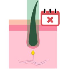 Phase télogène 1 Laser