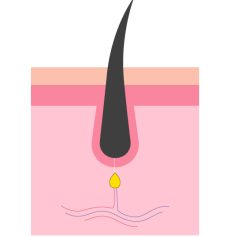 Phase télogène - Epilation laser pas efficace