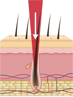 Fonctionnement de l'épilation laser